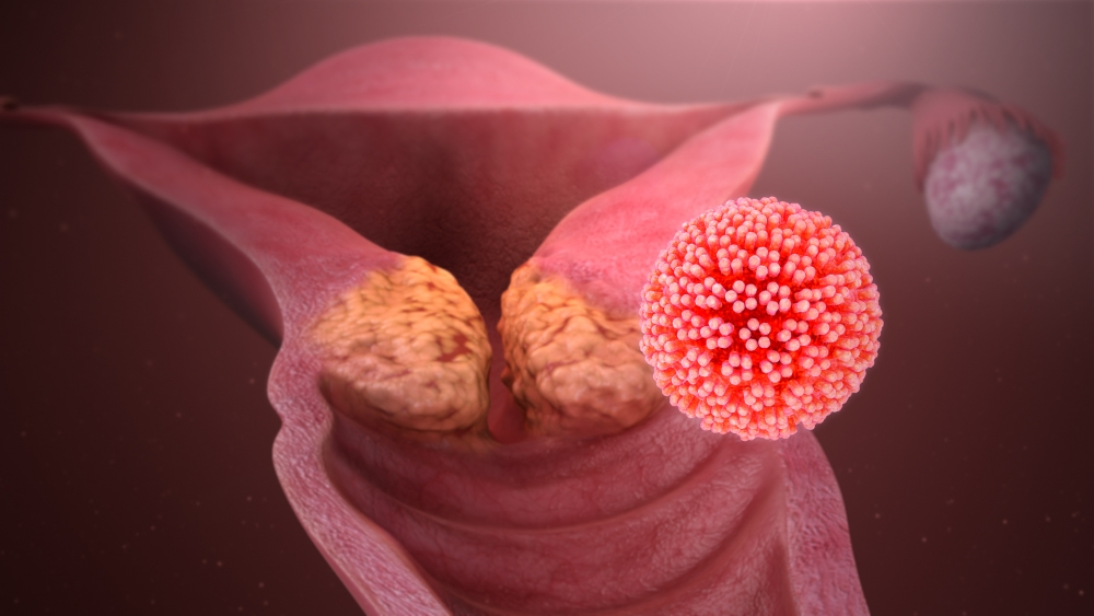 Diagnóstico y tratamiento del Virus del Papiloma Humano
