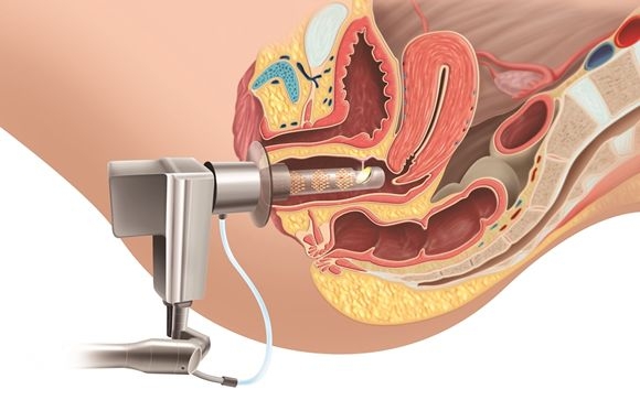 Atrofia vaginal: causas, consecuencias y tratamiento